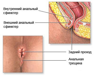 Fissura anal 