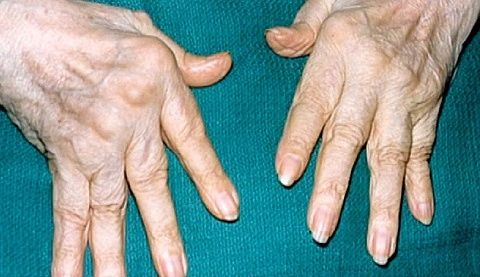 Dor nas articulações dos dedos