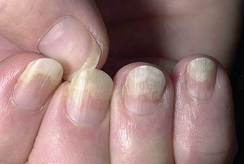 Peeling da placa de unhas de tecidos moles