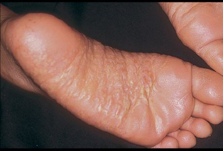 Dermatite das pernas e suas causas