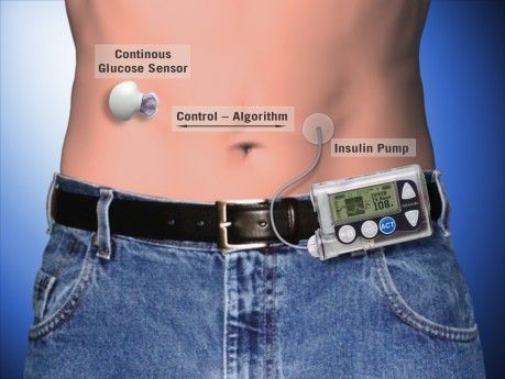 diabetes pancreas artificiais