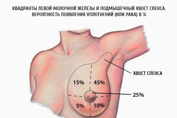 Os quadrantes da mama esquerda e a espinha axilar do spence.  A probabilidade de selos (ou câncer) em%