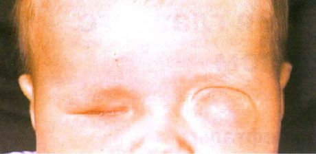 Microphthmus com formação de cisto concomitante (olho esquerdo).  Anophthalmus (olho direito).