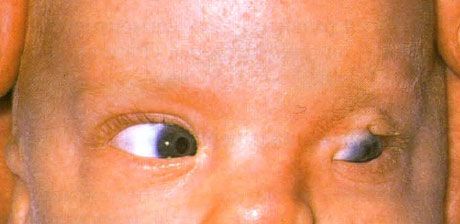 Síndrome de Fraser.  Criptoftalmos incompletos do olho esquerdo.