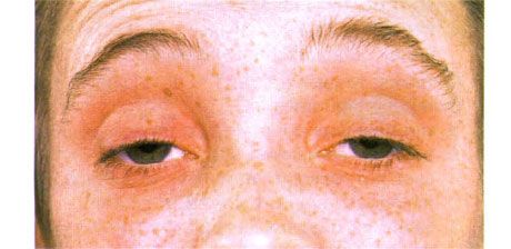 Oftalmoplegia externa.  Ptose de dois lados.  O paciente abre os olhos levantando as sobrancelhas