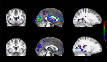 A varredura mostra áreas de atividade cerebral em resposta a estímulos em pessoas com um metabolismo rápido da nicotina (linha superior) e um metabolismo lento da nicotina (linha inferior)