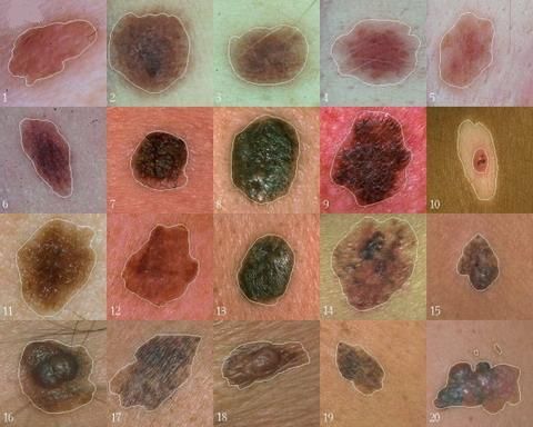 Os cientistas encontraram um gene que desempenha um papel central no desenvolvimento do melanoma