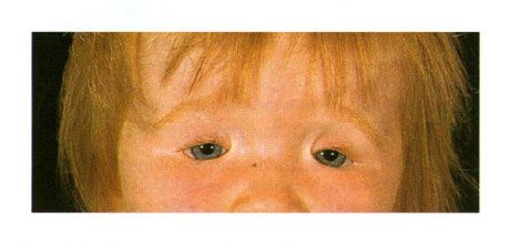 Coloboma de duas faces das pálpebras em uma criança com síndrome de Golden.  Encerramento da fenda do olho à esquerda